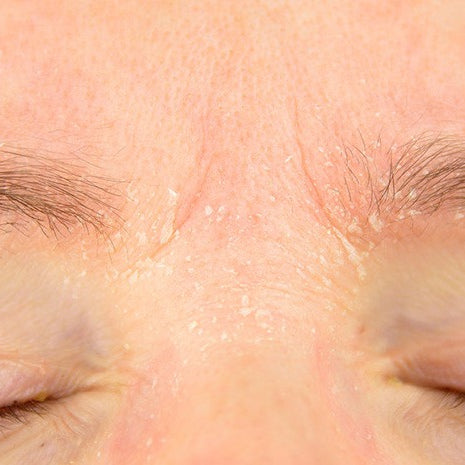 close up of eczema on woman's wrinkled brow